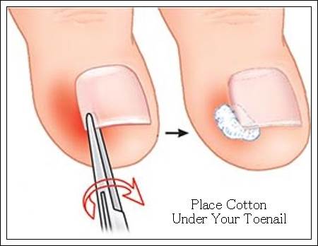 Relieve Ingrown Toenail Pain - Place Cotton Under Your Toenail fancynailart.com