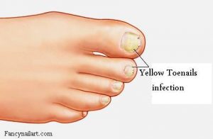 Yellow Toenails -What Causes Yellow Toenails And Treatment