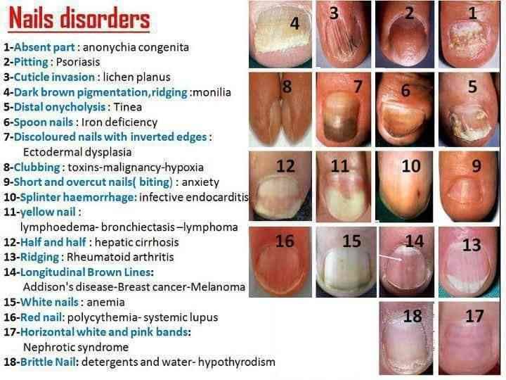 What Are Nail Abnormalities Clues To Systemic Disease Causes