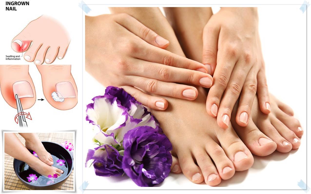 Relieve Ingrown Toenail Pain Do's & Don'ts Pedicure Tips