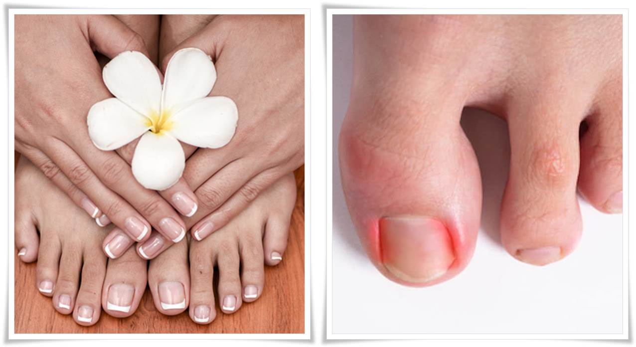 Toenail Fungus Treatment Home Remedies - Best Toenail Fungus Remedy