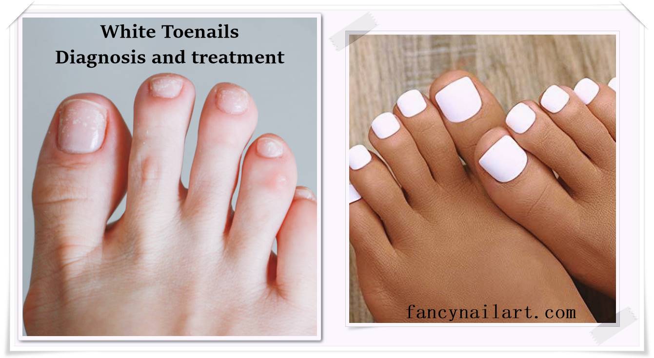 White Toenails - Diagnosis and treatment